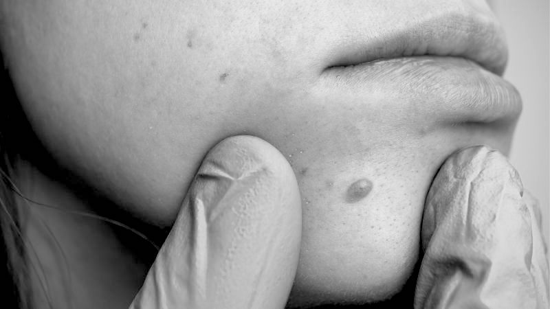 Cost of Skin Tags Removal Treatment in Northampton