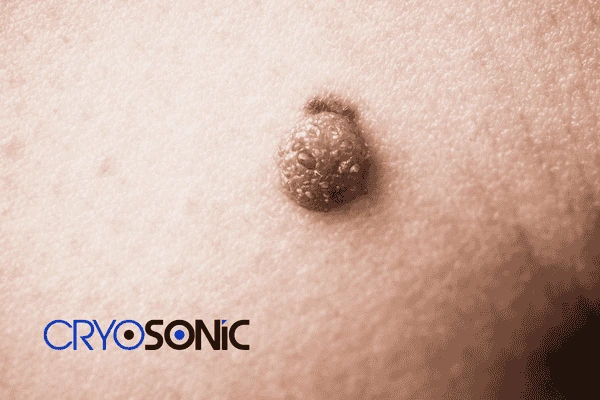 Looking for non surgical Dermatofibroma removal Northampton? Contact us today Northampton