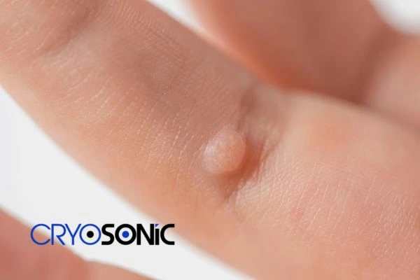 Contact Cryosonic today to learn more about us Northampton now! Northampton