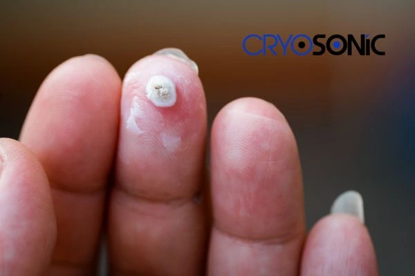 Learn more about us Northampton at Cryosonic. Book in today! Northampton