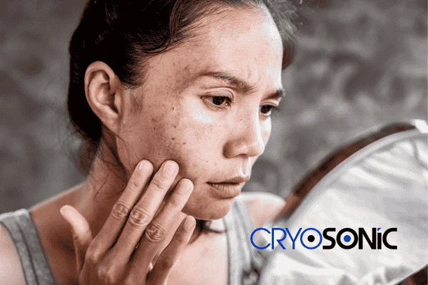 Book your sun damaged skin treatment online today in Northampton