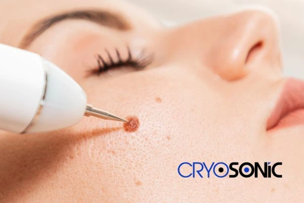 why choose us at Cryosonic for blemish removal? Find out more now Northampton