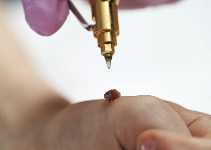 Cryopen For Children Bristol Northampton