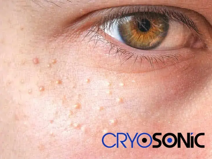 Cryosonic&rsquo;s CryoPen Approach to Milia Removal Northampton Northampton