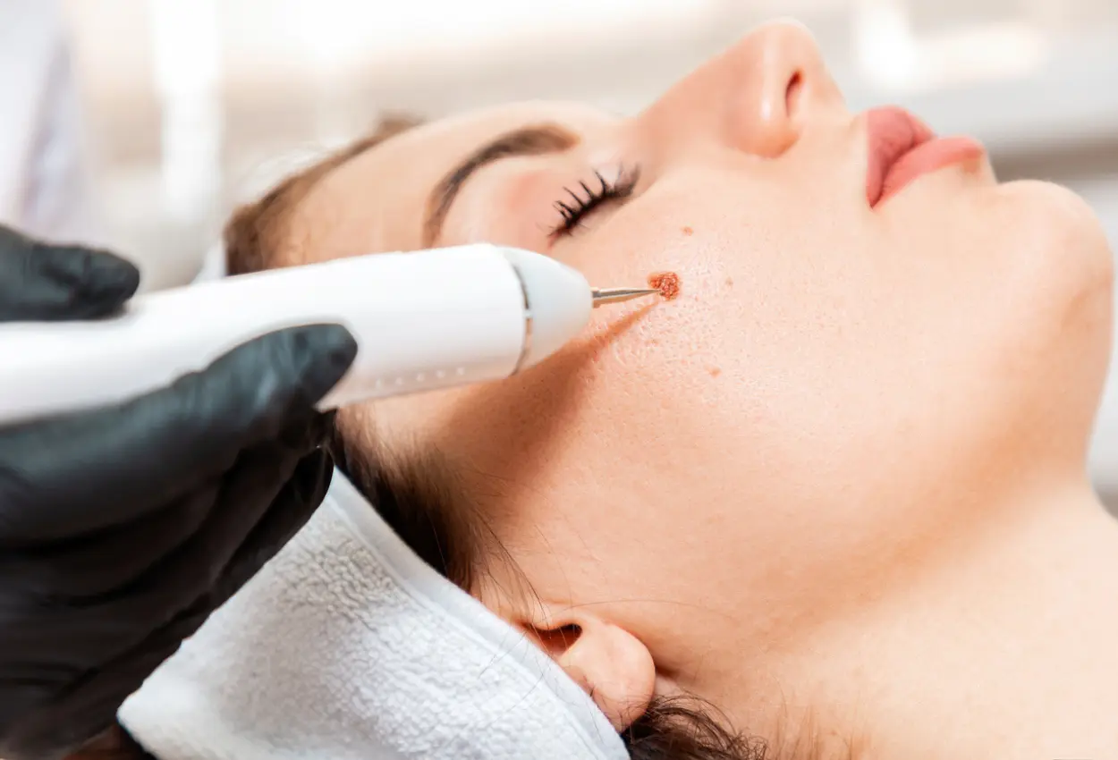 Frequently Asked Questions About Multiple Cryotherapy Treatments Northampton