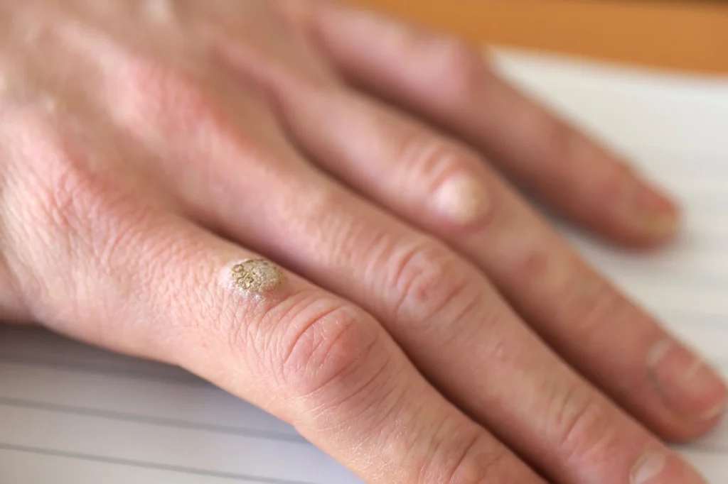 What to Expect After Warts Removal in Northampton Northampton