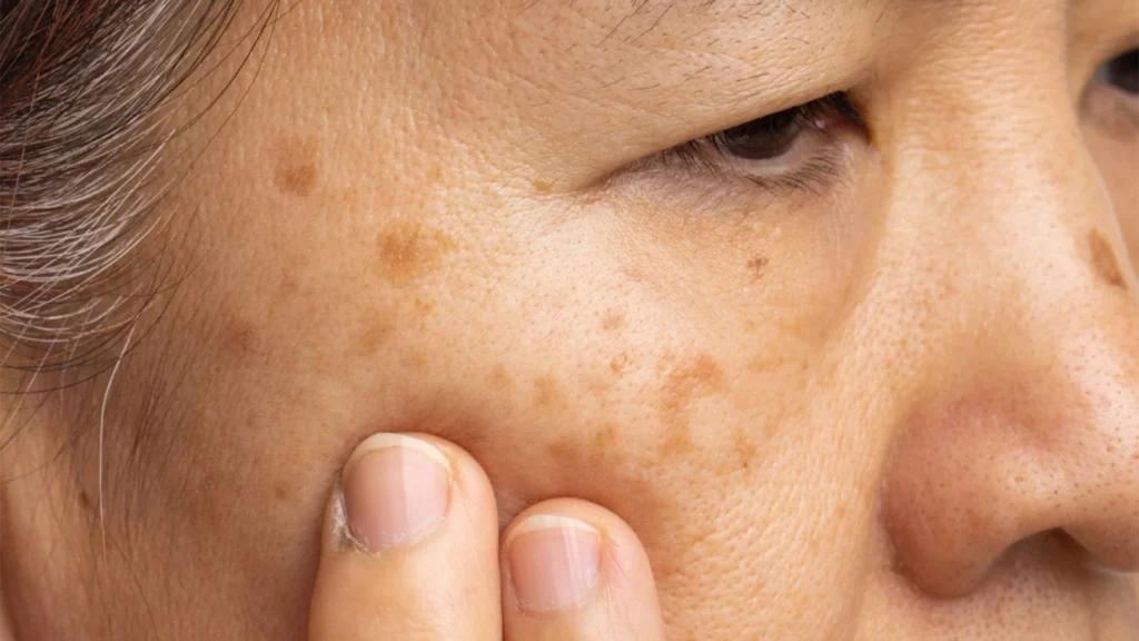 Seborrhoeic Keratosis Healing Process and Aftercare Advice Northampton