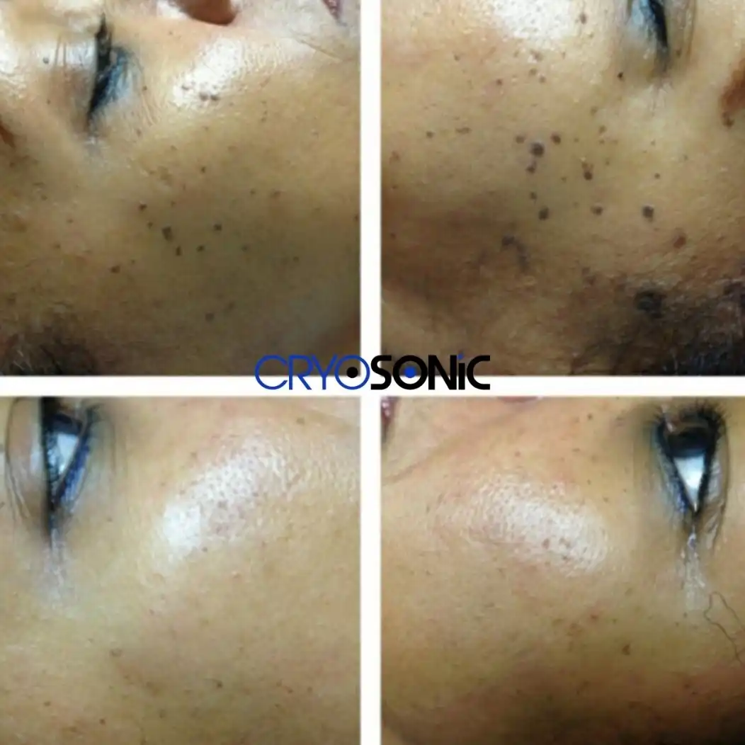 Why Skin Shows Pigmentation After Treatment Northampton