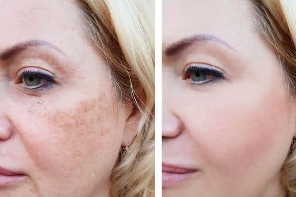 Before and after Ephelides Treatment Northampton