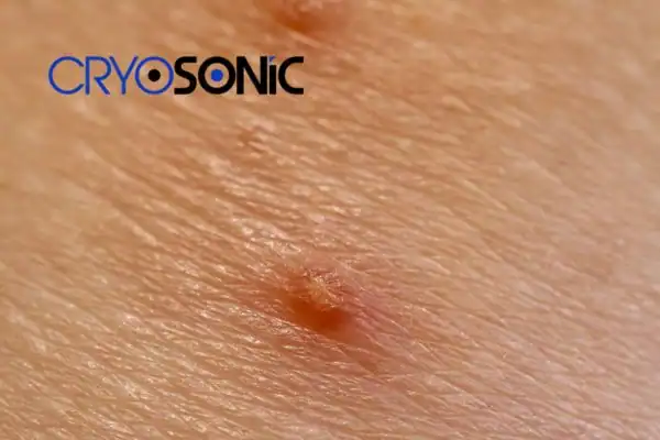 Molluscum Contagiosum Treatment Northampton Northampton