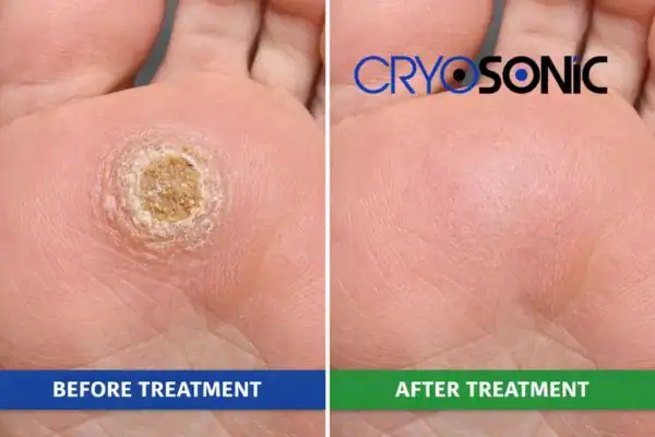 Before and after results of Porokeratosis Treatment Northampton Northampton