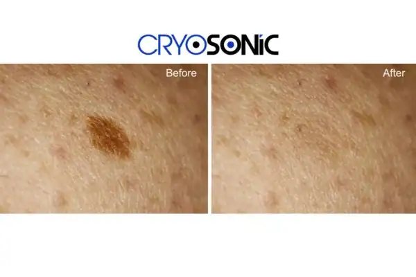 Before and after age spot removal Northampton Northampton
