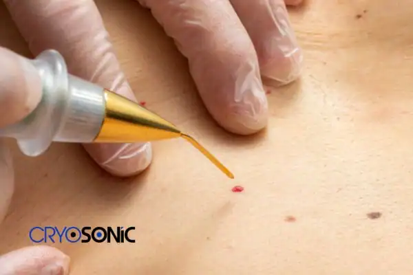 Image of cherry angioma removal Northampton Northampton