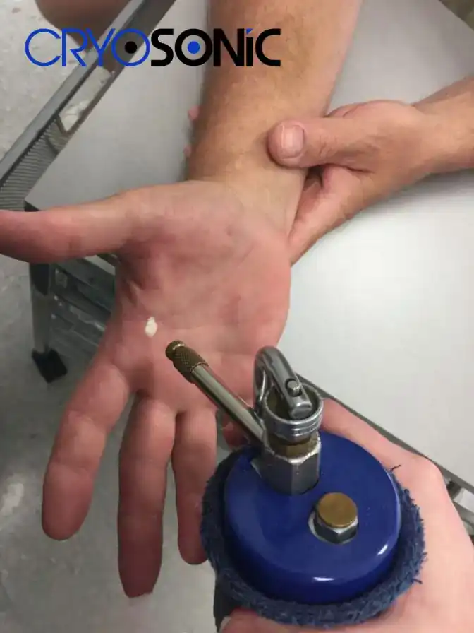 Temperature Differences: OTC vs Medical-Grade Cryotherapy Northampton